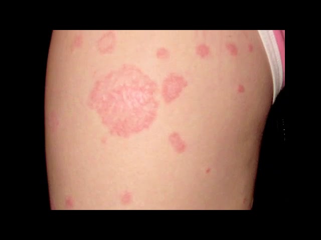 sexually transmitted ringworm