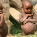 FG children northeast northwest malnutrition