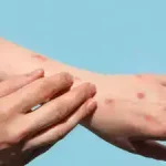 Congo Mpox Vaccination