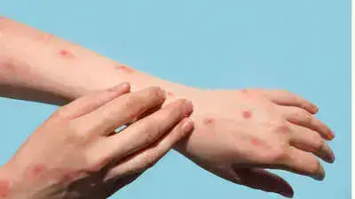 Congo Mpox Vaccination